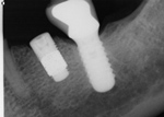 Zimmer trabecular metal implant and conventional implant
